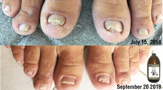 how-to-get-rid-of-foot-fungus-fast-naturally-ana-naturals